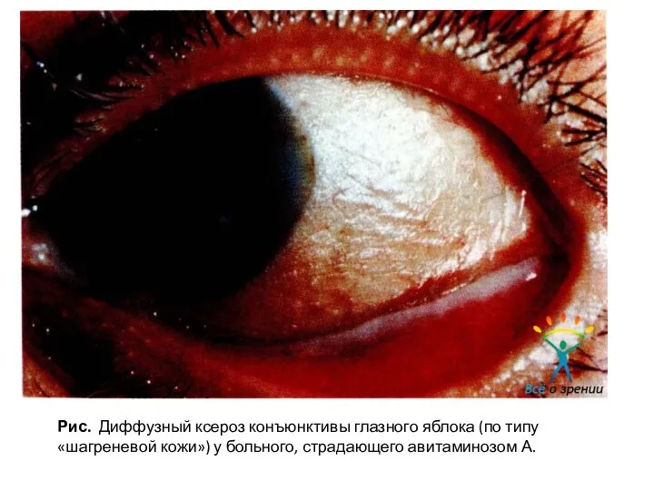Рис. Диффузный ксероз конъюнктивы глазного яблока (по типу «шагреневой кожи») у больного, страдающего авитаминозом А.