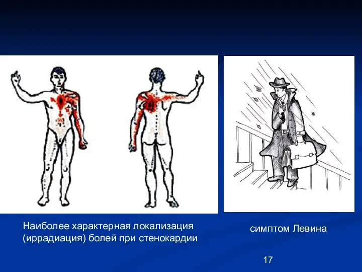 симптом Левина Наиболее характерная локализация (иррадиация) болей при стенокардии