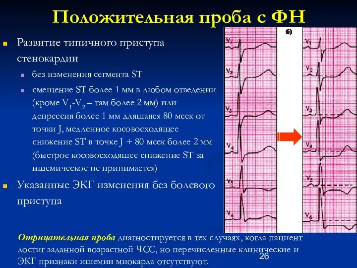 Положительная проба с ФН Развитие типичного приступа стенокардии без изменения сегмента