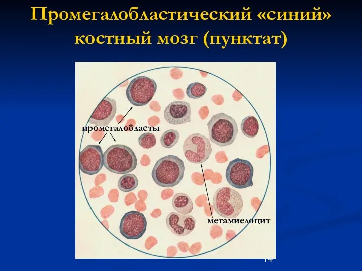 Промегалобластический «синий» костный мозг (пунктат) промегалобласты метамиелоцит