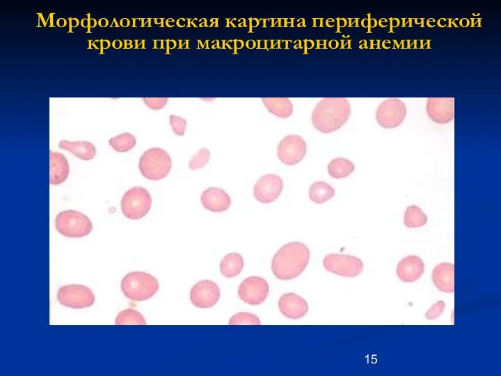 Морфологическая картина периферической крови при макроцитарной анемии