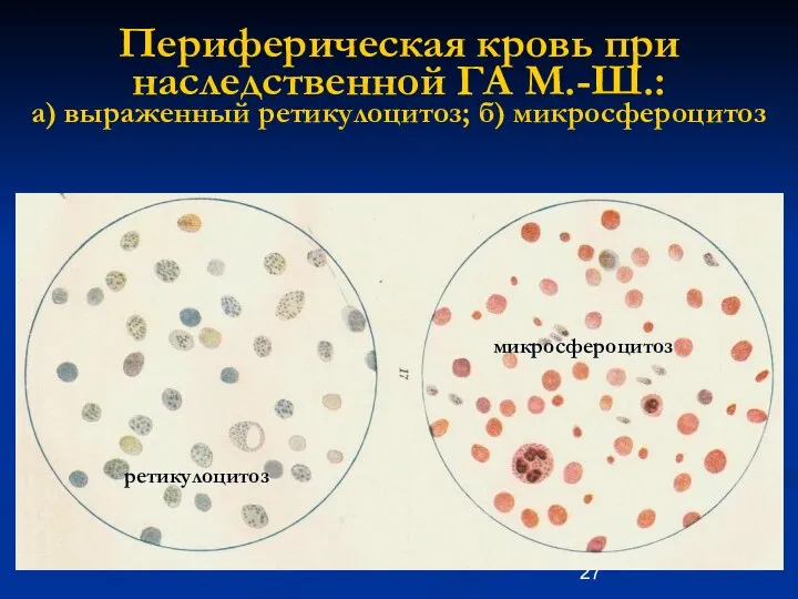 Периферическая кровь при наследственной ГА М.-Ш.: а) выраженный ретикулоцитоз; б) микросфероцитоз ретикулоцитоз микросфероцитоз