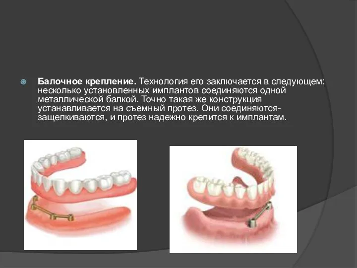 Балочное крепление. Технология его заключается в следующем: несколько установленных имплантов соединяются