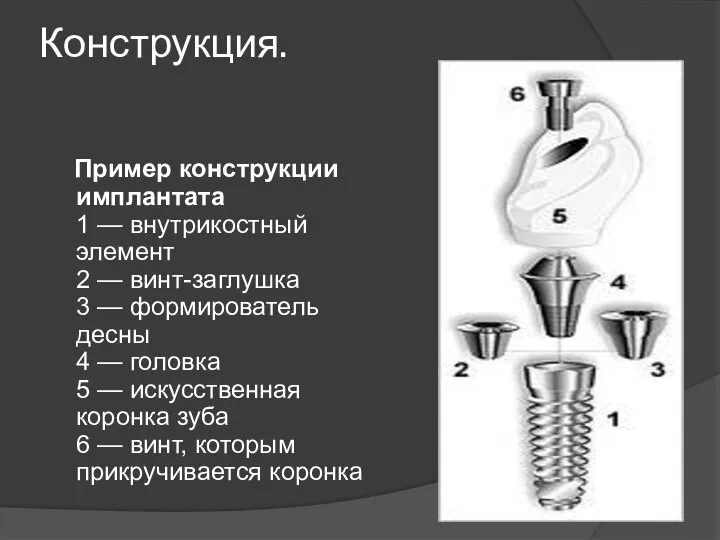 Конструкция. Пример конструкции имплантата 1 — внутрикостный элемент 2 — винт-заглушка