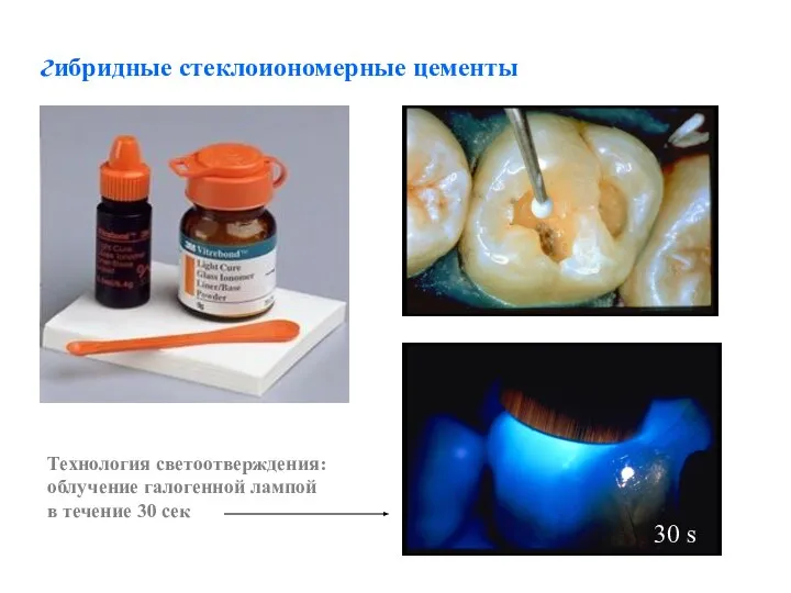 гибридные стеклоиономерные цементы 30 s Технология светоотверждения: облучение галогенной лампой в течение 30 сек