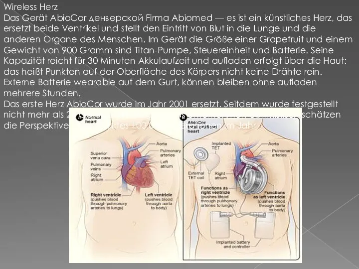 Wireless Herz Das Gerät AbioCor денверской Firma Abiomed — es ist