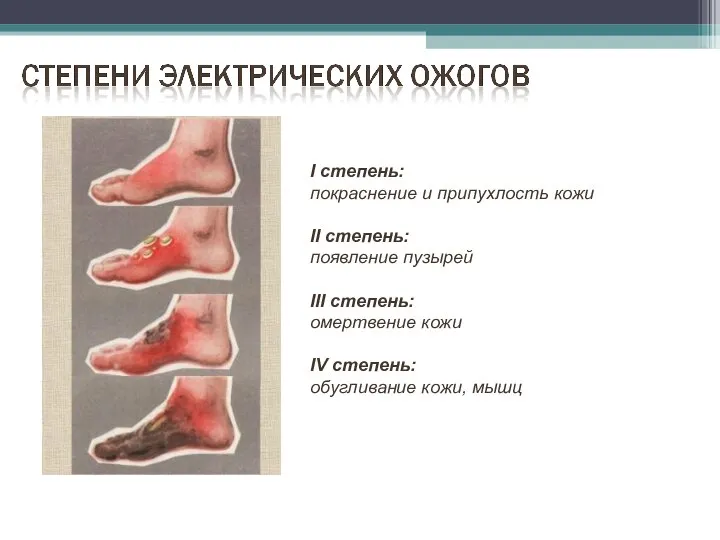 I степень: покраснение и припухлость кожи II степень: появление пузырей III