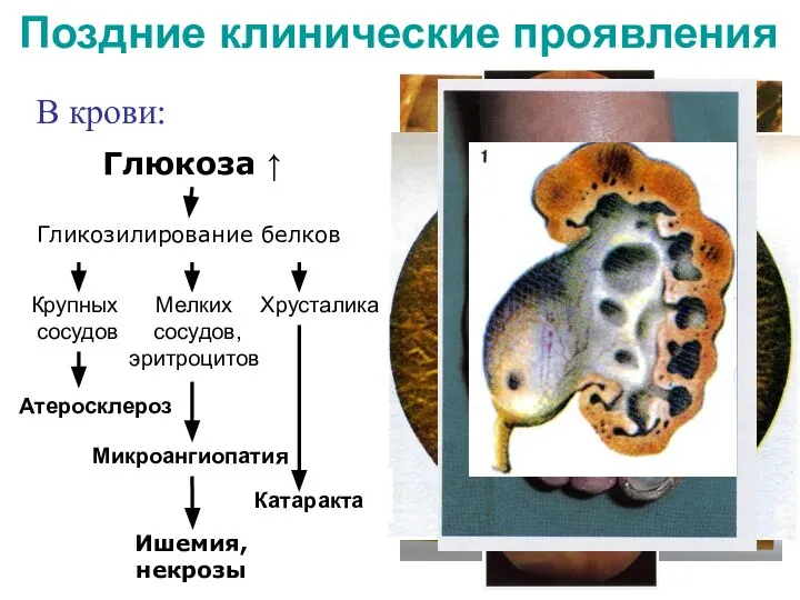 Поздние клинические проявления В крови: Глюкоза ↑ Гликозилирование белков Атеросклероз Катаракта