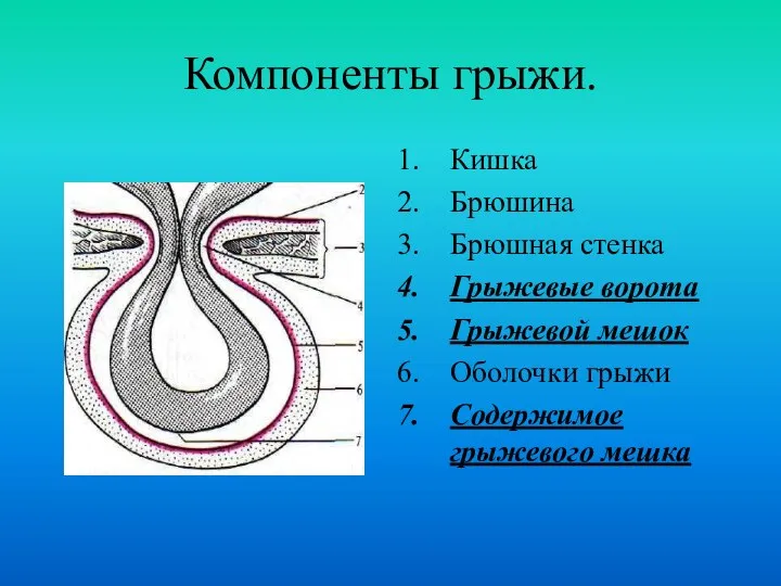 Компоненты грыжи. Кишка Брюшина Брюшная стенка Грыжевые ворота Грыжевой мешок Оболочки грыжи Содержимое грыжевого мешка