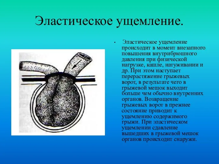 Эластическое ущемление. Эластическое ущемление происходит в момент внезапного повышения внутрибрюшного давления