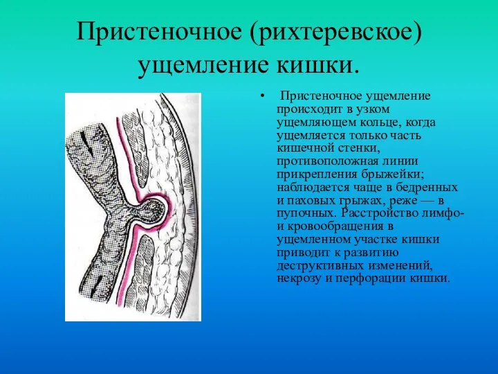 Пристеночное (рихтеревское) ущемление кишки. Пристеночное ущемление происходит в узком ущемляющем кольце,