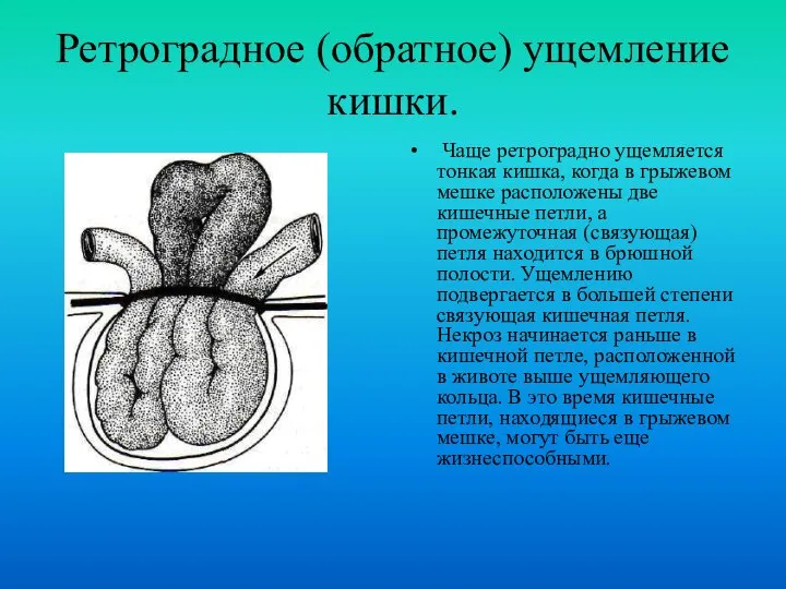 Ретроградное (обратное) ущемление кишки. Чаще ретроградно ущемляется тонкая кишка, когда в