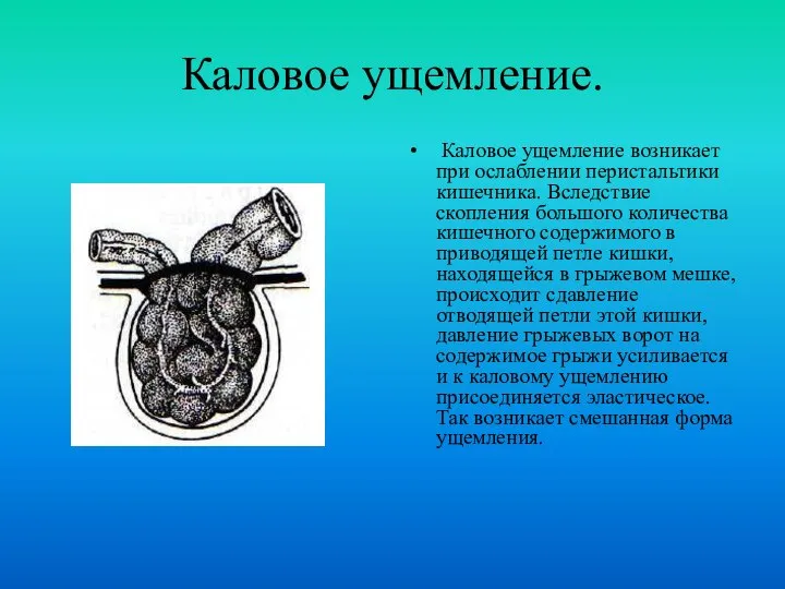 Каловое ущемление. Каловое ущемление возникает при ослаблении перистальтики кишечника. Вследствие скопления