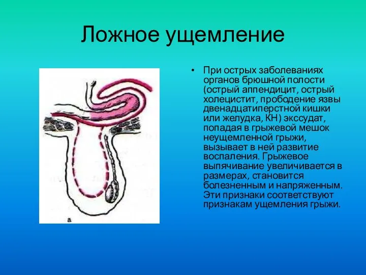 Ложное ущемление При острых заболеваниях органов брюшной полости (острый аппендицит, острый