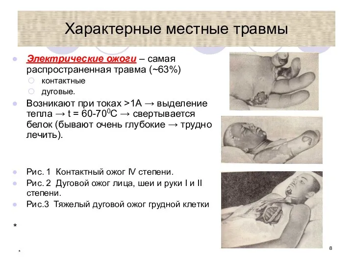 * Характерные местные травмы Электрические ожоги – самая распространенная травма (~63%)