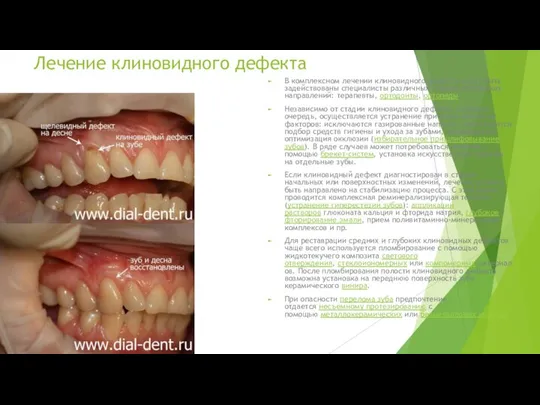 Лечение клиновидного дефекта В комплексном лечении клиновидного дефекта могут быть задействованы