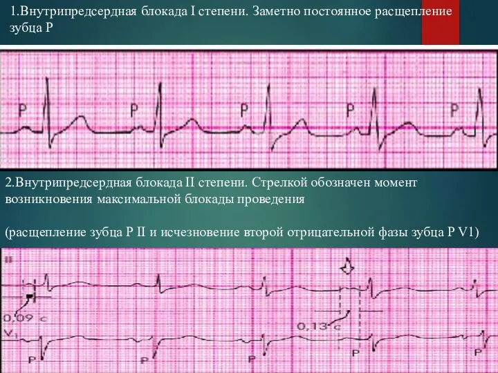 1.Внутрипредсердная блокада I степени. Заметно постоянное расщепление зубца Р 2.Внутрипредсердная блокада