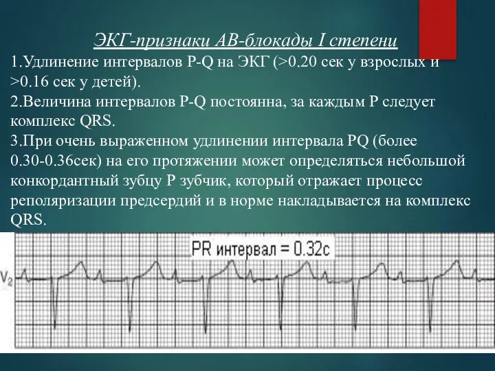 ЭКГ-признаки АВ-блокады I степени 1.Удлинение интервалов P-Q на ЭКГ (>0.20 сек