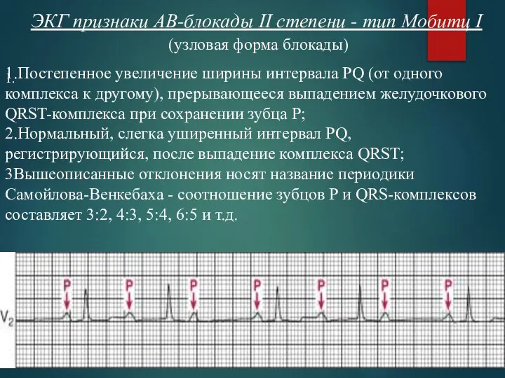 ЭКГ признаки АВ-блокады II степени - тип Мобитц I 1. (узловая