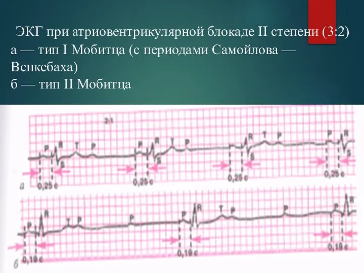 ЭКГ при атриовентрикулярной блокаде II степени (3:2) а — тип I