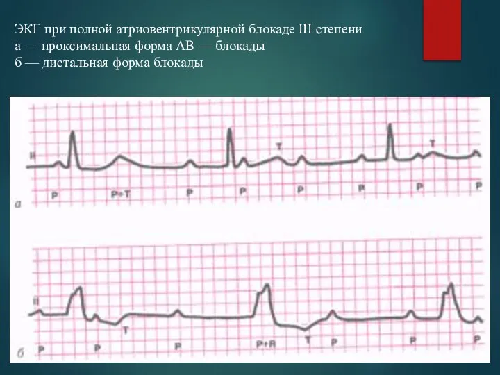 ЭКГ при полной атриовентрикулярной блокаде III степени а — проксимальная форма