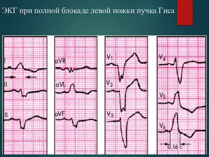 ЭКГ при полной блокаде левой ножки пучка Гиса