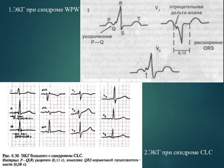 1.ЭКГ при синдроме WPW 2.ЭКГ при синдроме СLC