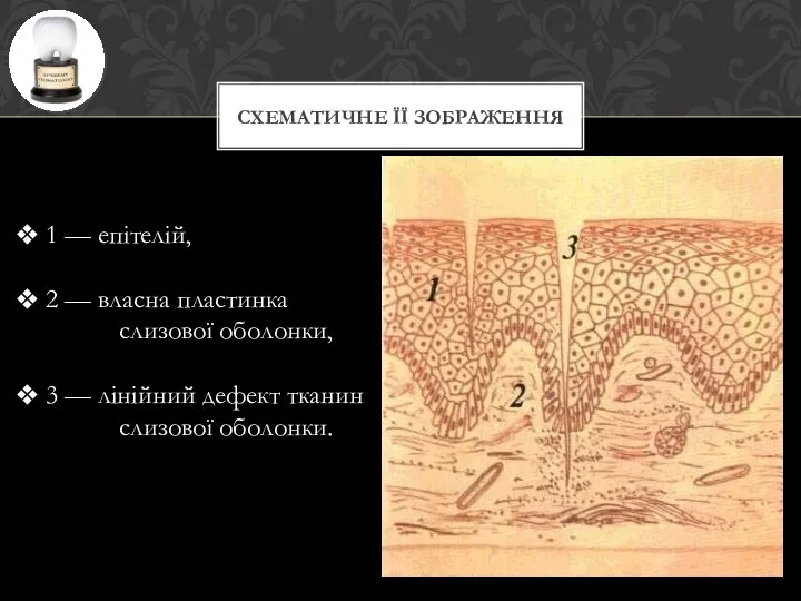 СХЕМАТИЧНЕ ЇЇ ЗОБРАЖЕННЯ 1 — епітелій, 2 — власна пластинка слизової