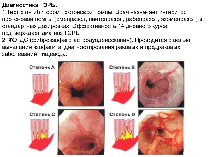 Диагностика ГЭРБ. 1.Тест с ингибитором протоновой помпы. Врач назначает ингибитор протоновой