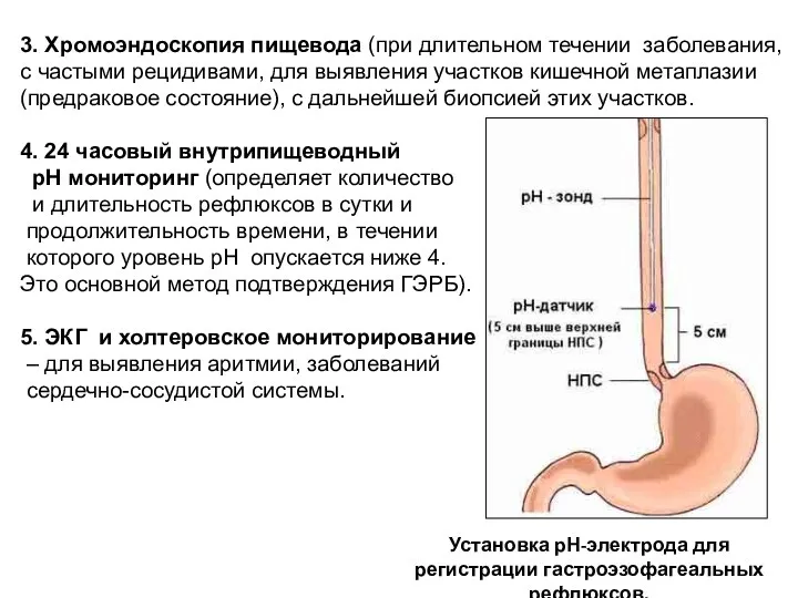 3. Хромоэндоскопия пищевода (при длительном течении заболевания, с частыми рецидивами, для