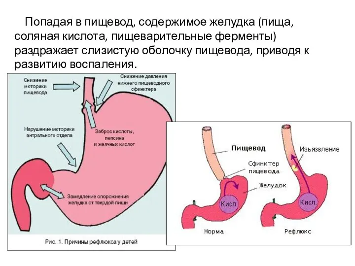 Попадая в пищевод, содержимое желудка (пища, соляная кислота, пищеварительные ферменты) раздражает