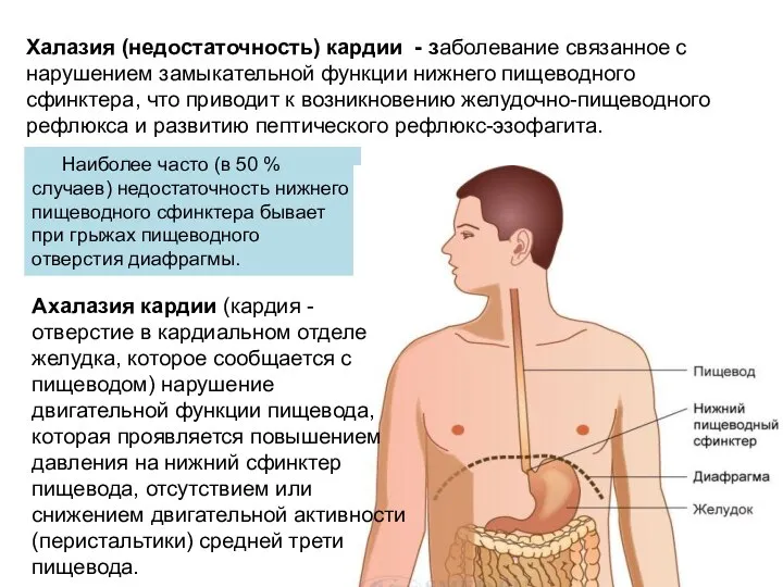 Халазия (недостаточность) кардии - заболевание связанное с нарушением замыкательной функции нижнего