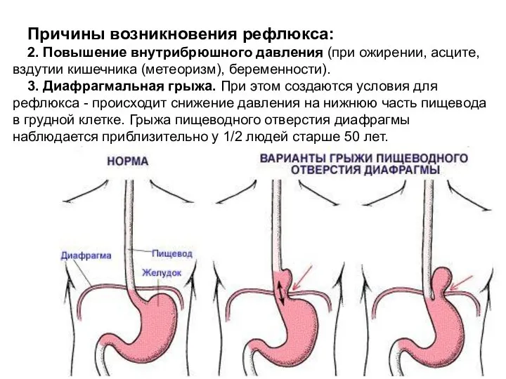 Причины возникновения рефлюкса: 2. Повышение внутрибрюшного давления (при ожирении, асците, вздутии