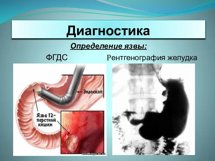 Диагностика Определение язвы: ФГДС Рентгенография желудка