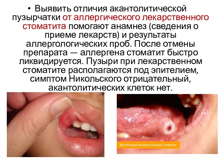 Выявить отличия акантолитической пузырчатки от аллергического лекарственного стоматита помогают анамнез (сведения