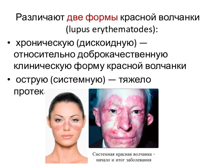 Различают две формы красной волчанки (lupus erythematodes): хроническую (дискоидную) — относительно