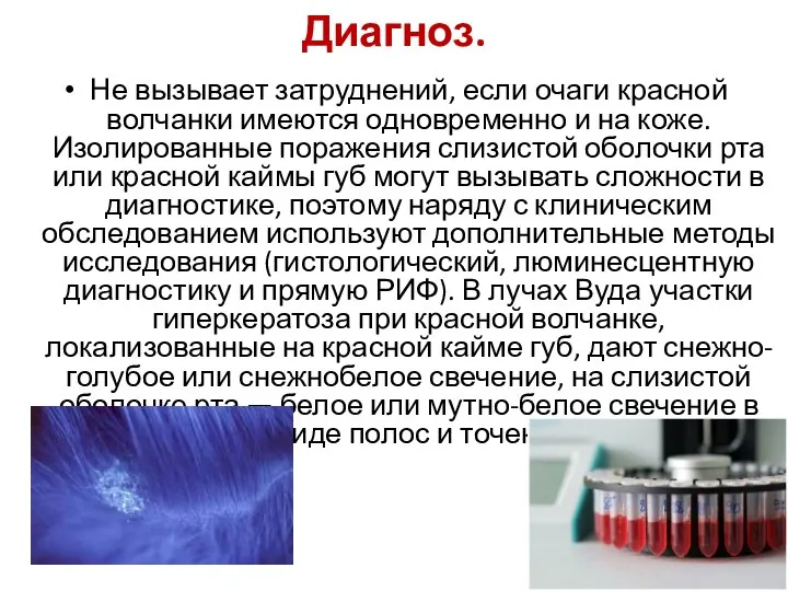 Диагноз. Не вызывает затруднений, если очаги красной волчанки имеются одновременно и