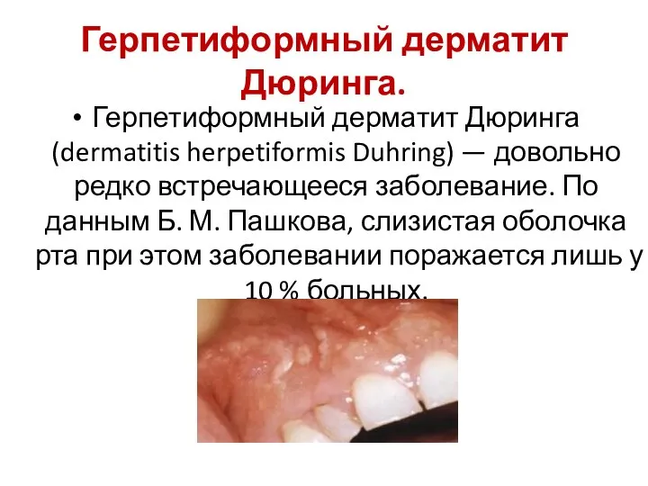 Герпетиформный дерматит Дюринга. Герпетиформный дерматит Дюринга (dermatitis herpetiformis Duhring) — довольно