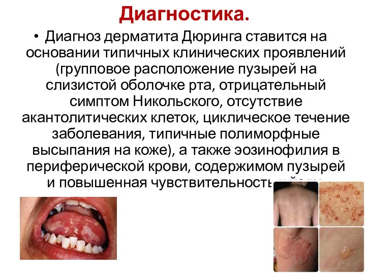 Диагностика. Диагноз дерматита Дюринга ставится на основании типичных клинических проявлений (групповое