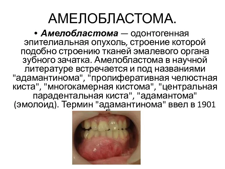 АМЕЛОБЛАСТОМА. Амелобластома — одонтогенная эпителиальная опухоль, строение которой подобно строению тканей