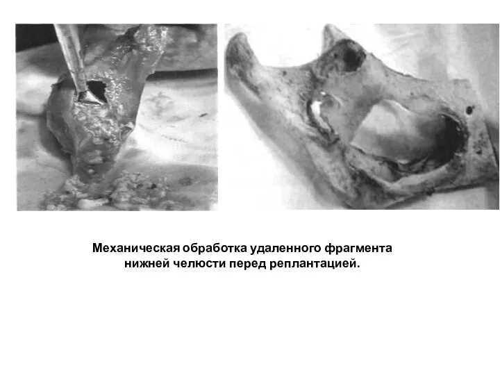 Механическая обработка удаленного фрагмента нижней челюсти перед реплантацией.