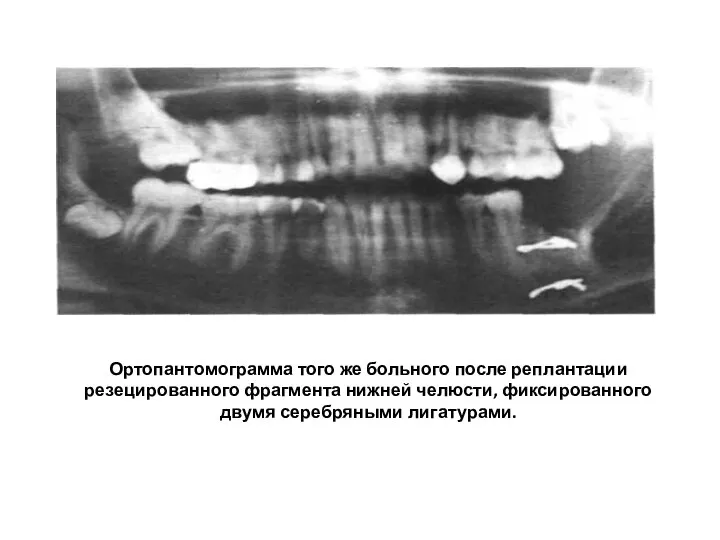 Ортопантомограмма того же больного после реплантации резецированного фрагмента нижней челюсти, фиксированного двумя серебряными лигатурами.