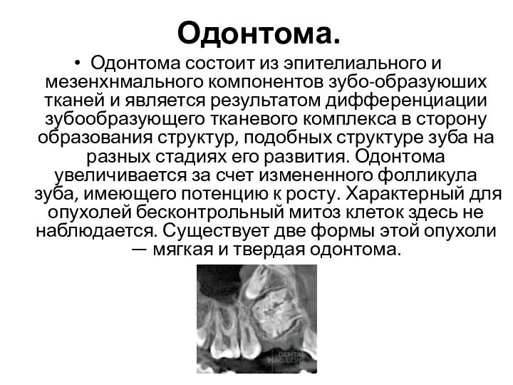 Одонтома. Одонтома состоит из эпителиального и мезенхнмального компонентов зубо-образуюших тканей и