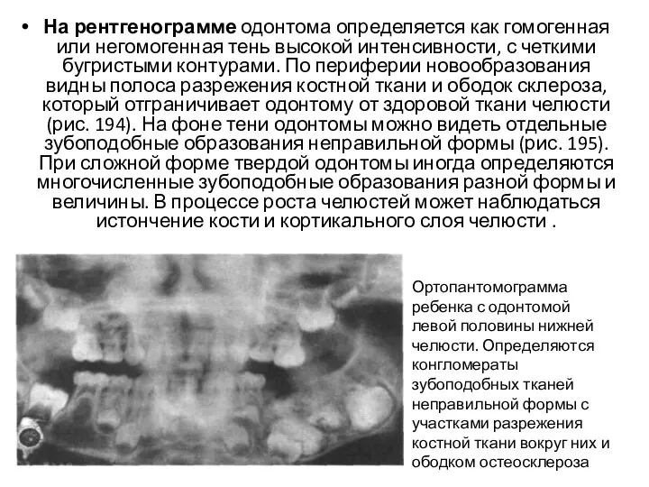 На рентгенограмме одонтома определяется как гомогенная или негомогенная тень высокой интенсивности,