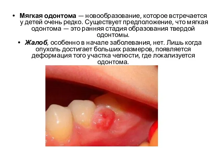 Мягкая одонтома — новообразование, которое встречается у детей очень ред­ко. Существует