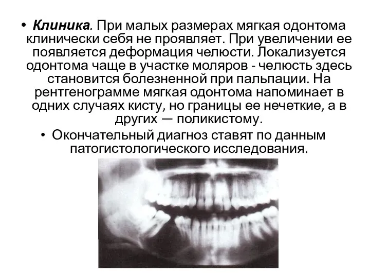 Клиника. При малых размерах мягкая одонтома клинически себя не проявляет. При