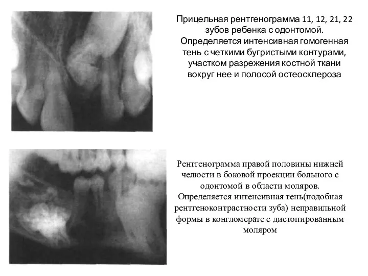 Прицельная рентгенограмма 11, 12, 21, 22 зубов ребенка с одонтомой. Определяется