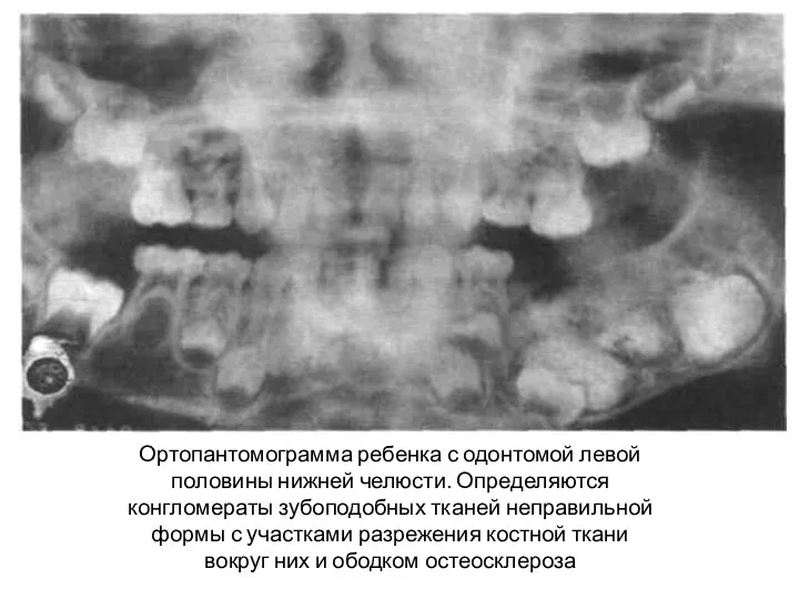 Ортопантомограмма ребенка с одонтомой левой половины нижней челюсти. Опре­деляются конгломераты зубоподобных