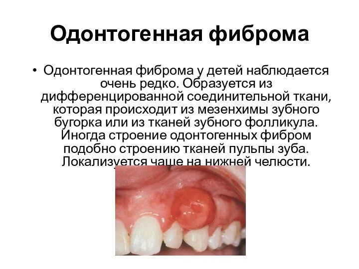 Одонтогенная фиброма Одонтогенная фиброма у детей наблюдается очень редко. Образуется из