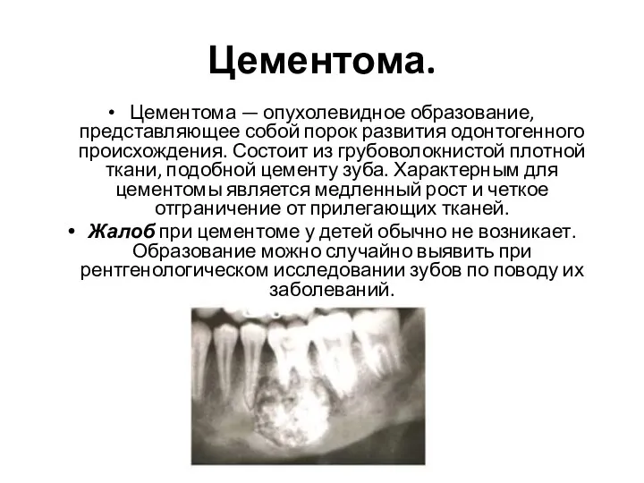 Цементома. Цементома — опухолевидное образование, представляющее собой порок раз­вития одонтогенного происхождения.